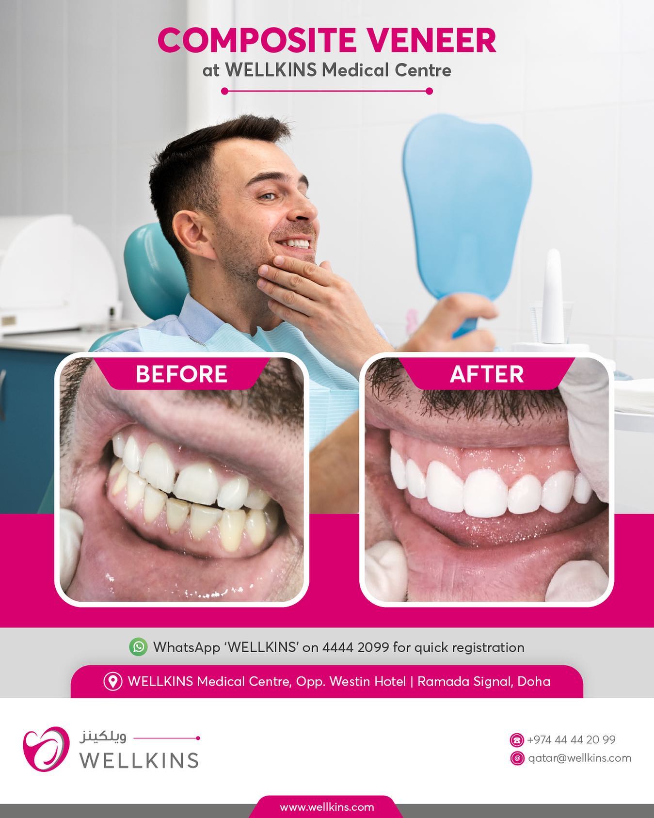Say goodbye to unsightly gaps, chips, and stains on your teeth! Composite veneers are a quick and easy solution for a flawless smile. Our veneers will fit on your teeth perfectly, and can be completed in just one appointment. Book your consultation now and get the smile of your dreams._______________________________
To learn more about #WELLKINSQATAR and our services, kindly visit our website www.wellkins.com
Helpline: 4444 2099
_______________________________
#Wellkinsqatar #wellkins #medicalcentre #Qatar2022 #dentalveneers