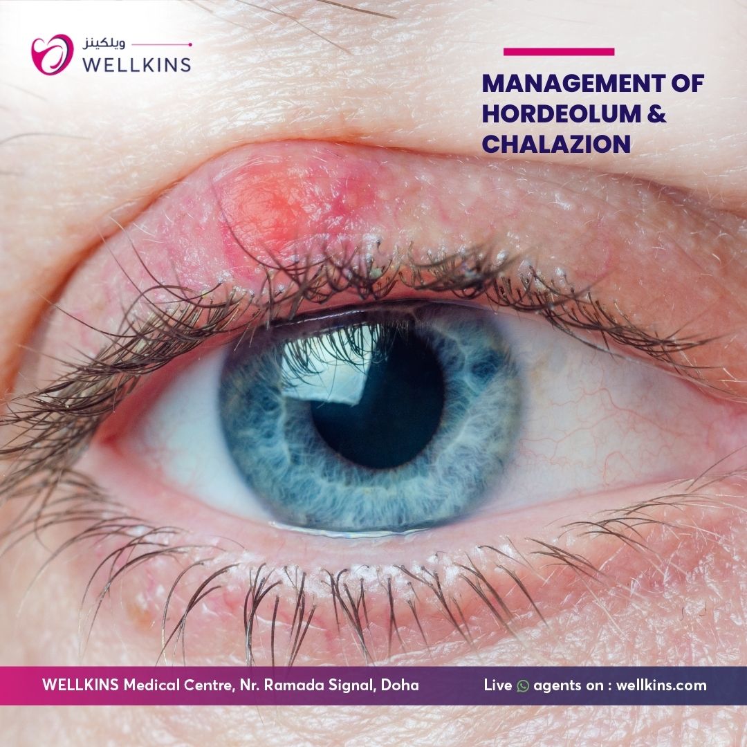 Management of Hordeolum and Chalazion Doha Qatar - Wellkins Medical Centre